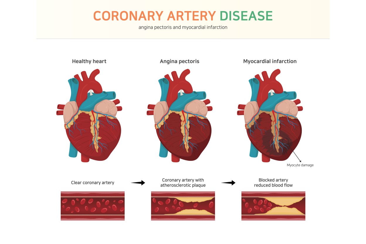 coronary-artery-disease-in-las-cruces