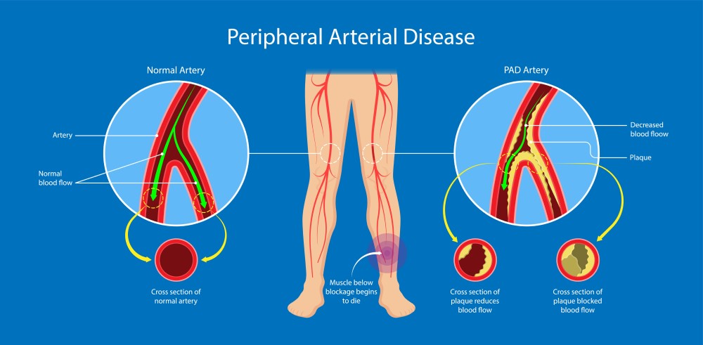 Peripheral Vascular Disease