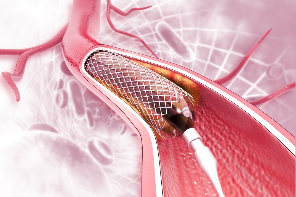 Coronary Artery Angioplasty / Stenting