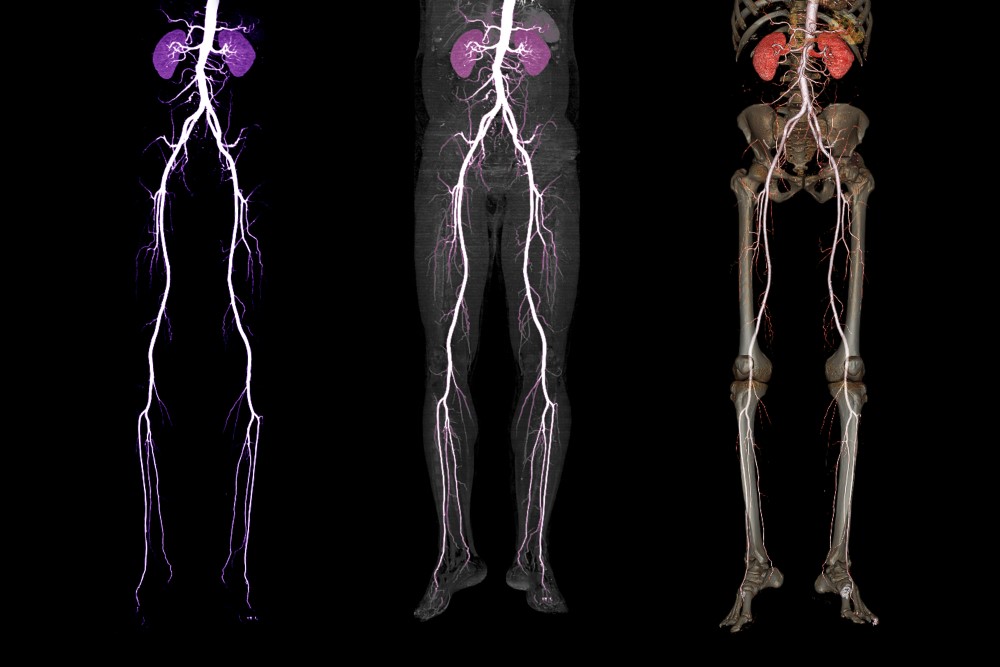 Peripheral Angiography