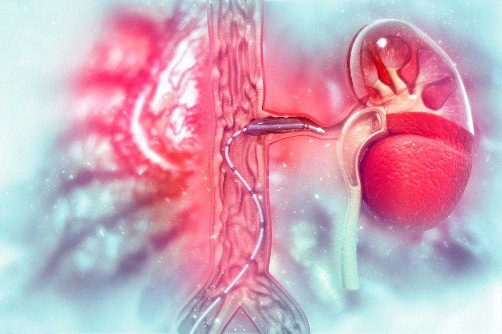 Peripheral Artery Angioplasty / Stenting