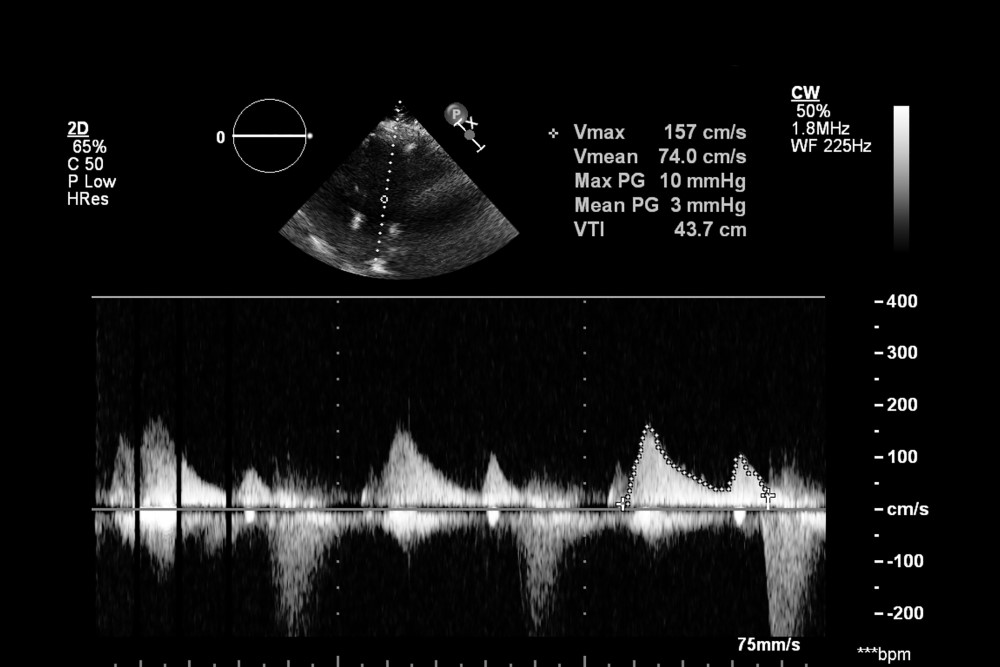 Transesophageal Echocardiogram (TEE)