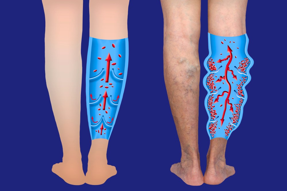 What are Varicose Veins? - Metropolitan Vascular Institute